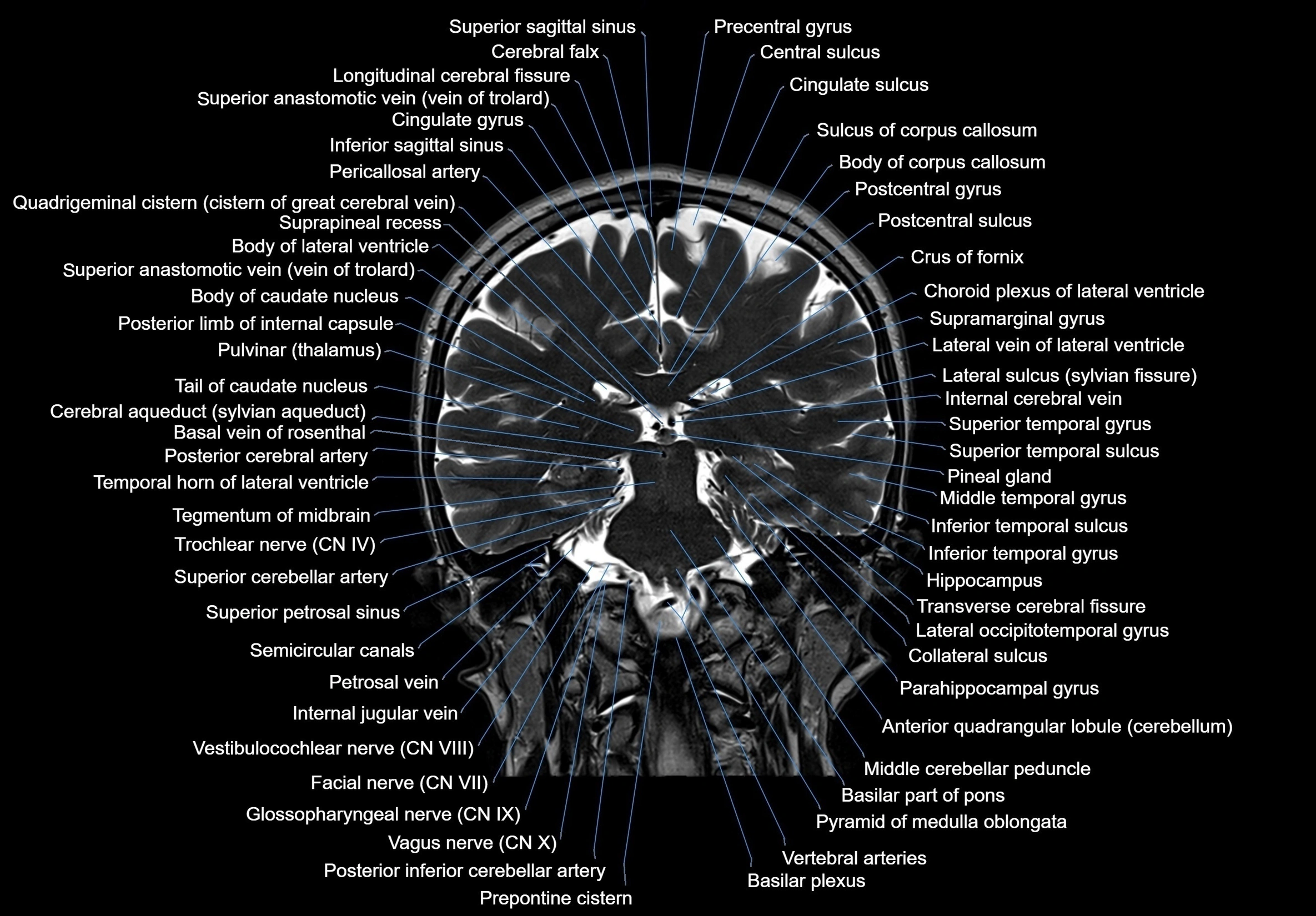 MRI Brain coronal cross sectional labelled anatomy 3T image  -img-00001-00045.webp